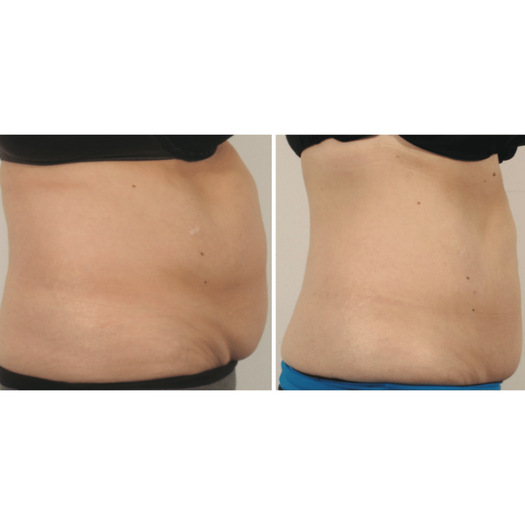 Non Surgical Liposuction And Fat Loss Treatment With Emerald Aetherclinic