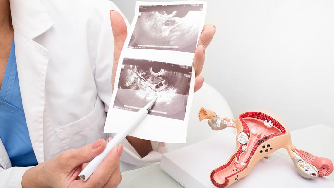 Penyebab Penebalan Dinding Rahim, Faktor Risiko, Gejala, dan Pengobatannya