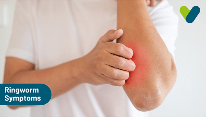 Ringworm Symptoms