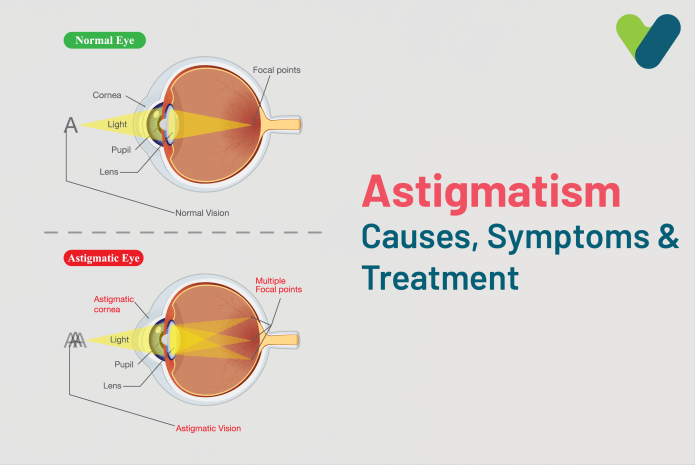 Astigmatism: Ultimate Guide To Causes, Symptoms & Treatment