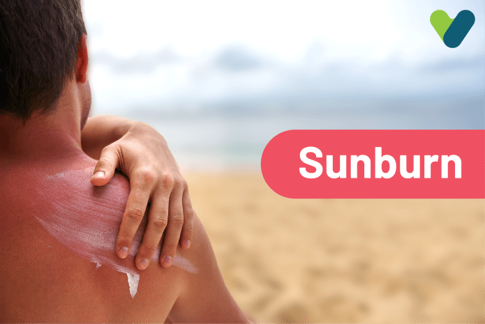 Sunburn : Complete Guide To Causes, Symptoms & Treatment