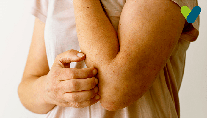 Atopic Dermatitis – Causes And Treatments