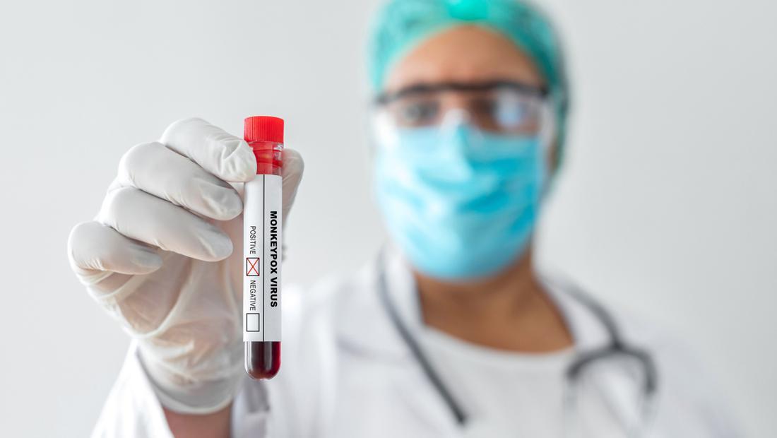 Fakta-fakta Clade 1b, Varian Mpox Mematikan yang Terdeteksi di Thailand
