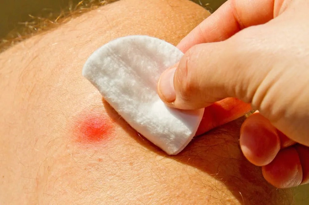 Pertolongan Pertama Mengatasi Gigitan Laba-Laba | Hello Sehat