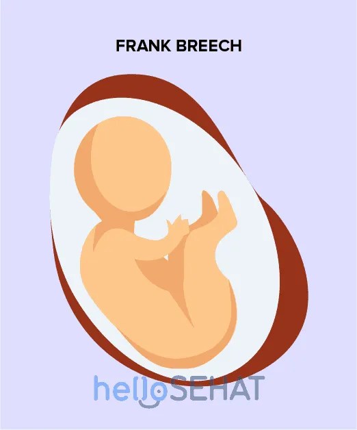 Bayi Sungsang Saat Hamil: Kenali Penyebab, Jenis, dan Solusi Terbaiknya