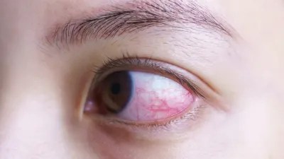 Mengenal Fungsi Sklera, Bagian Putih pada Bola Mata - Hello Sehat