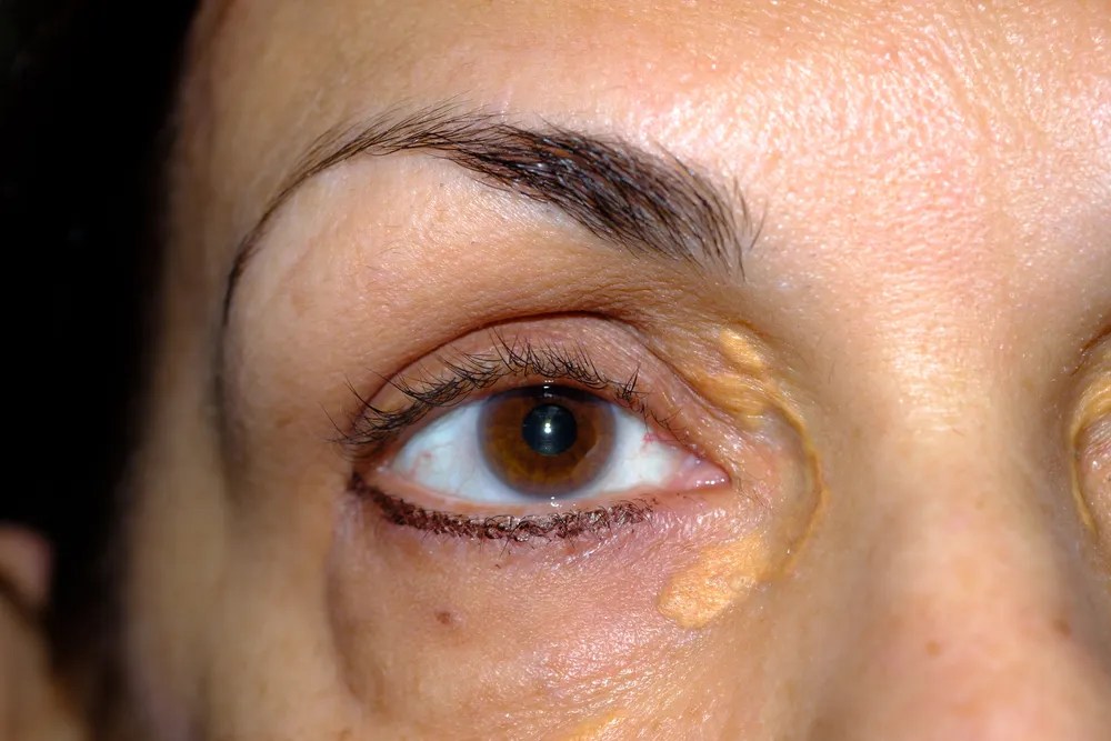 Xanthelasma, Penyebab Adanya Lemak di Dekat Kelopak Mata | Hello Sehat