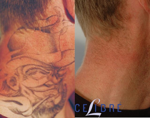 Laser Tattoo Removal In Orange County, Torrance And La 505_x_640_jpg