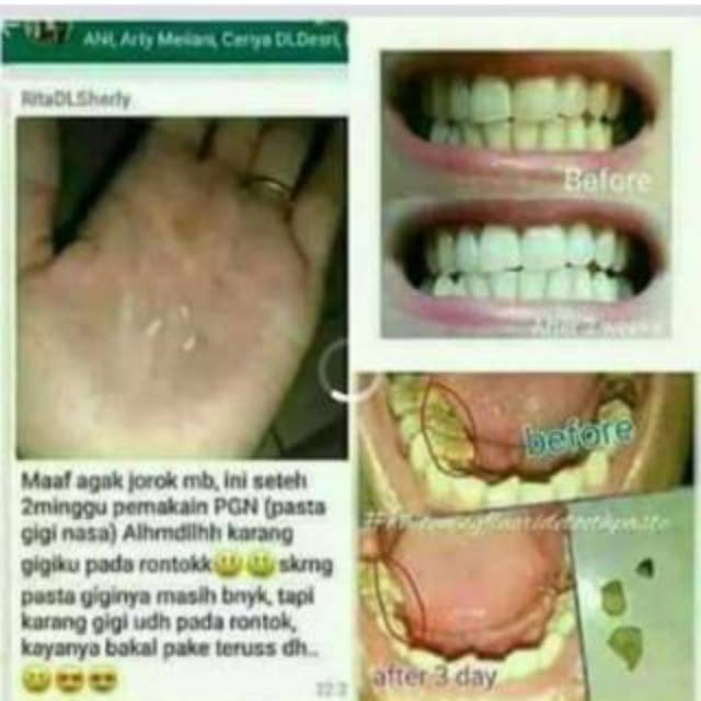 Pasta Gigi Nasa Atasi sakit gigi,gusi ngilu,karang gigi ji | Shopee  Indonesia