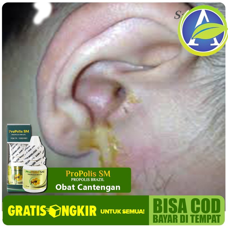 Obat Congek, Tuli Sebelah Kiri dan Kanan, Budek, Budeg Herbal PROPOLIS SM  100% ASLI Paling | Shopee Indonesia