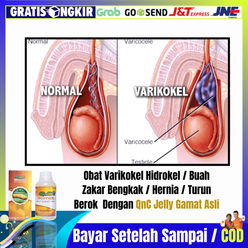 Obat Varikokel Hidrokel / Buah Zakar Bengkak / Hernia / Turun Berok Dengan  QnC Jelly Gamat Asli | Shopee Indonesia