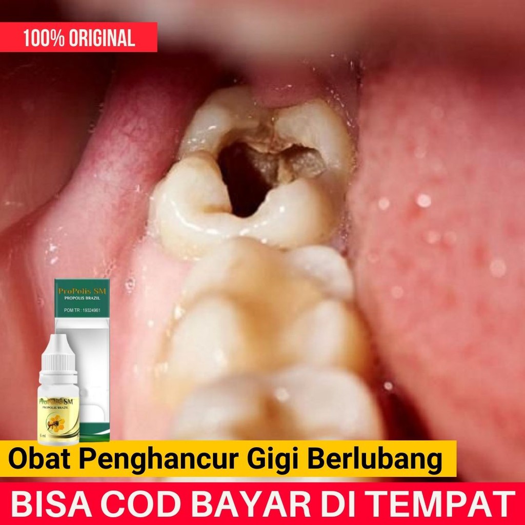 Tips Menghilangkan Sakit Gigi Berlubang