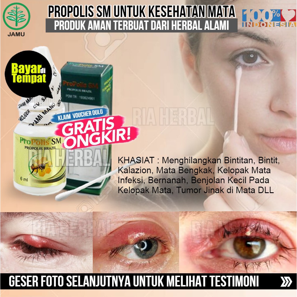 Jual Obat Kelopak Mata Bengkak, Salep Benjolan Milia Millia Skin Tag, Kutil  Daging Tumbuh DiKelopak Mata Indonesia|Shopee Indonesia