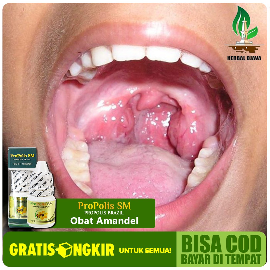 Obat Amandel Tonsilitis Kronis - Radang Sakit Tenggorokan - Sulit/Susah  Menelan Herbal Propolis SM | Shopee Indonesia