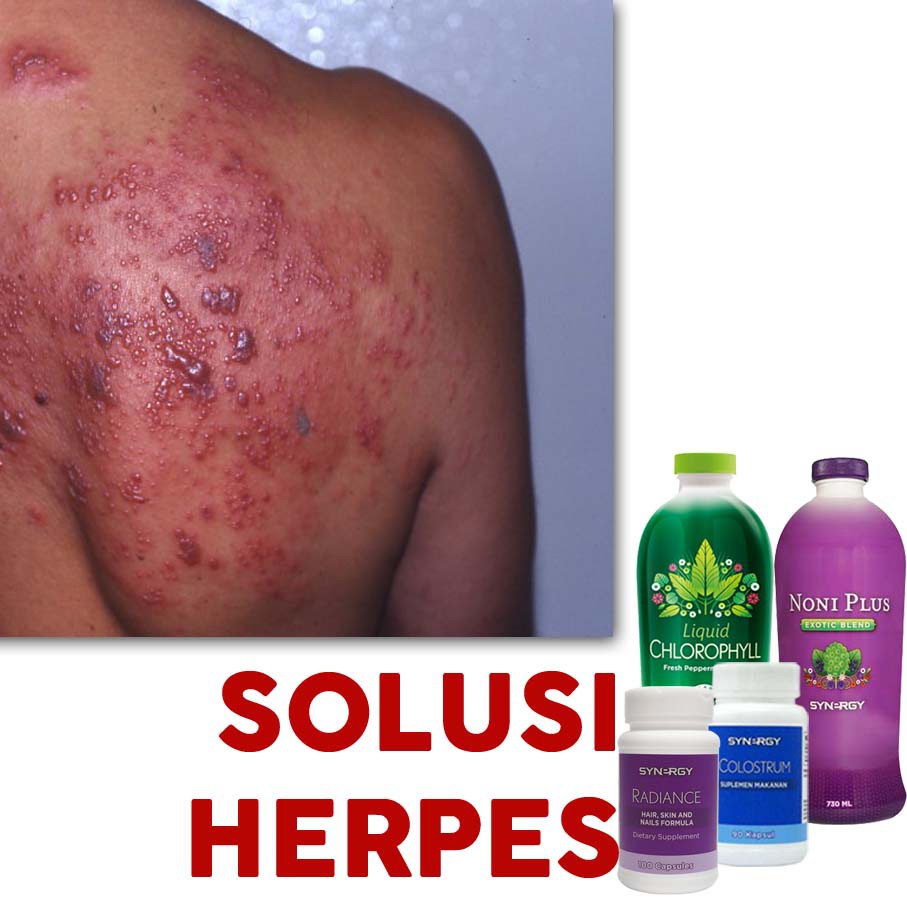 Jual Obat Cacar Api / Herpes &amp; Gejala Migrain-Demam Ekstrak Daun &amp; Susu  Indonesia|Shopee Indonesia