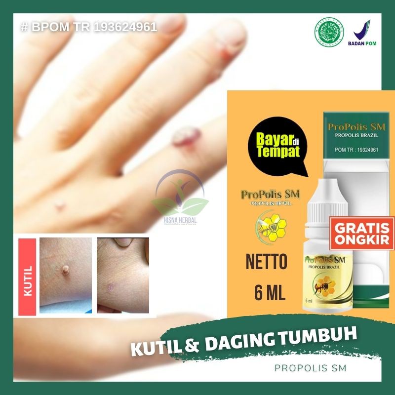 OBAT MENGHILANGKAN KUTIL, PENGHILANG KUTILAN DI TANGAN LEHER, WAJAH,  KEPALA, KAKI, BIBIR PROPOLIS SM | Shopee Indonesia