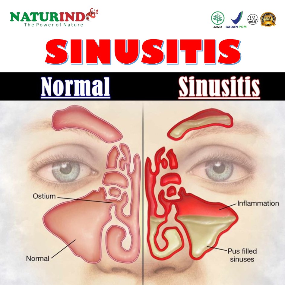 Jual Obat Sinusitis Polip Hidung Radang Hidung Infeksi Hidung Bengkak Radang  Hidung Alami Naturindo Indonesia|Shopee Indonesia