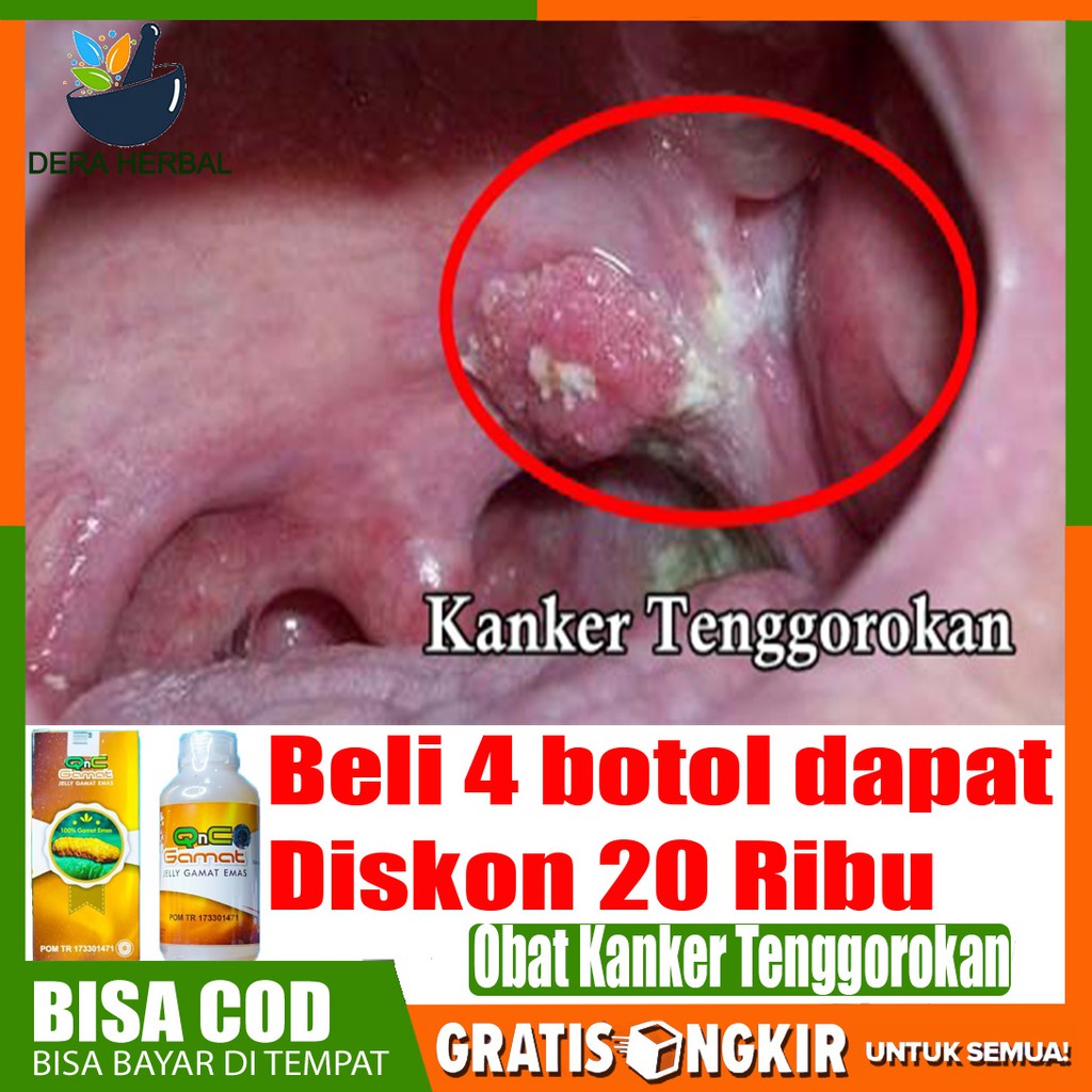 Obat kanker tenggorokan obat radang tenggorokan obat amandel Qnc Jelly  Gamat Original | Shopee Indonesia