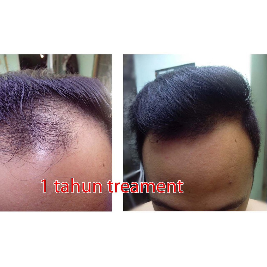 Solusi Rambut Botak Menumbuhkan Rambut Botak Dalam 2 Minggu Dan Hasil  Permanen Tanpa Ketergantungan | Shopee Indonesia