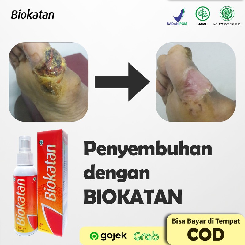 Jual Perawatan Luka Diabetes di Rumah dengan Obat Herbal BIOKATAN SPRAY  Indonesia|Shopee Indonesia