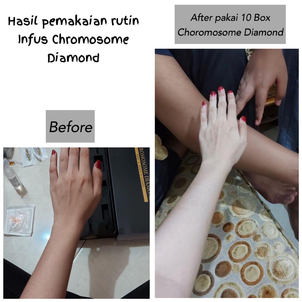 Harga Infus Kromosom