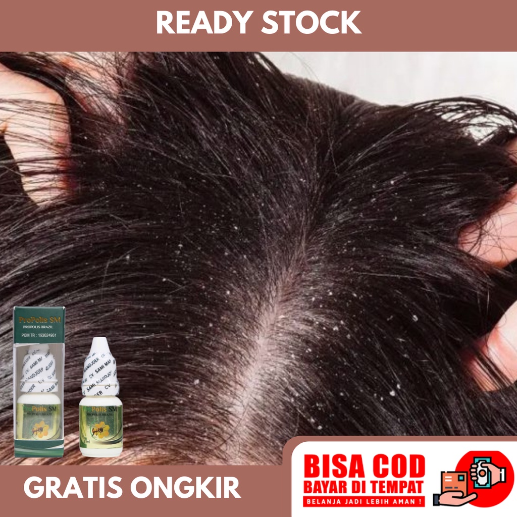 Obat Ketombe Rambut, Ketombe Kering, Ketombe Basah, Ketombe Berkerak,  Ketombe Gatal - Propolis SM | Shopee Indonesia