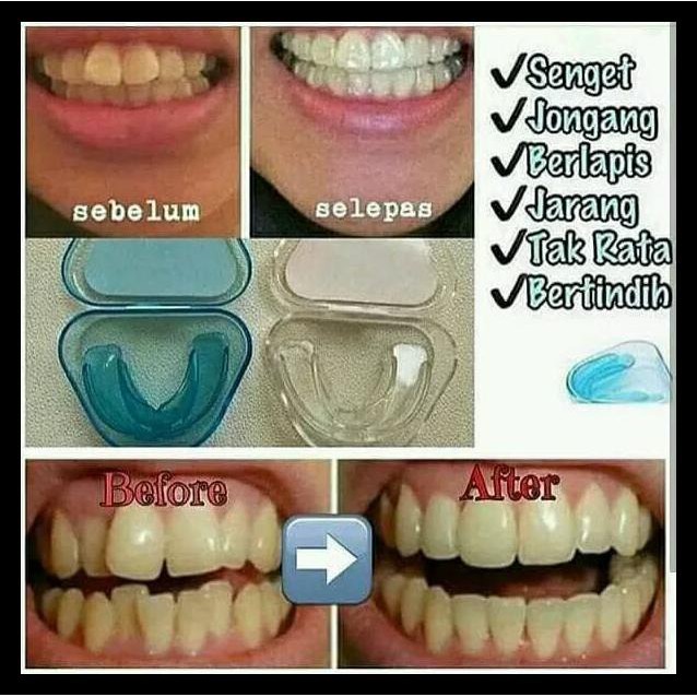 TERLARIS! alat merapikan gigi - teeth trainer alighment - behel gigi ajaib  | Shopee Indonesia