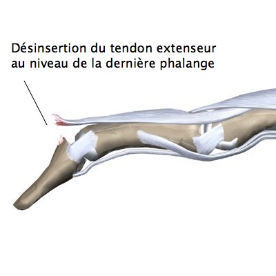Mallet Finger ou Doigt en Maillet - Chirurgie de la MainChirurgie de la Main