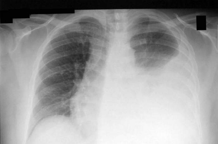 Diagnostica Per Immagini Del Torace In Emergenza-Urgenza: Rx Ed Ecografia 465_x_700_jpg