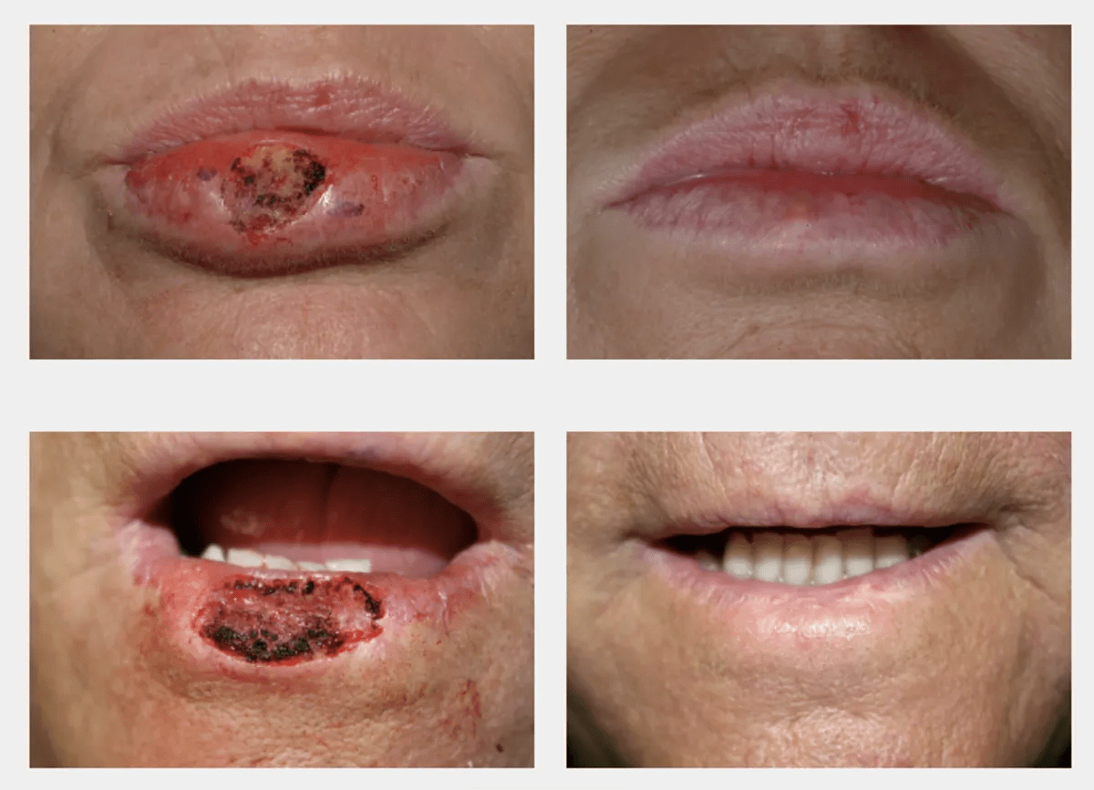 Dunkler fleck an der lippe