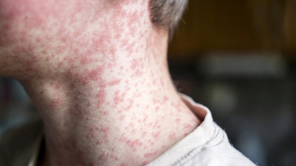 Morbillo, un italiano su 10 a rischio infezione: il report ISS
