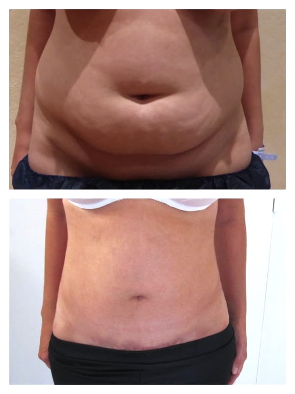 Vais-je perdre du poids avec une abdominoplastie ?