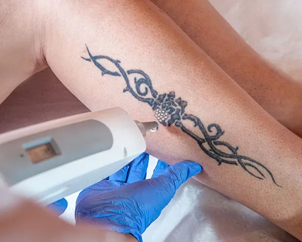 Permanent Laser Tattoo Removal In Jersey City, Nj 480_x_600_webp