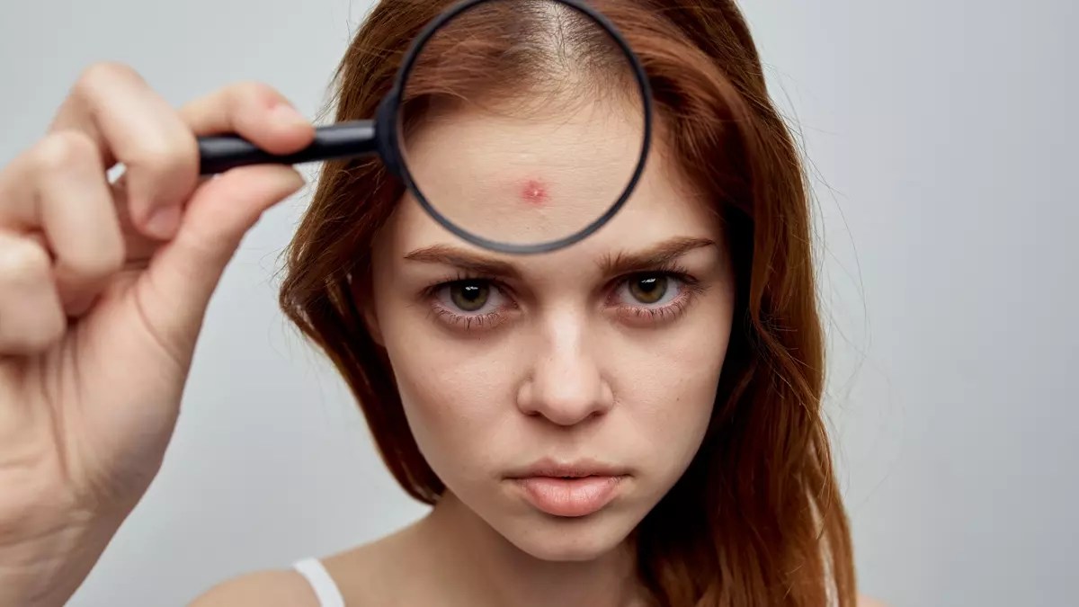 اسباب حبوب الجبهة