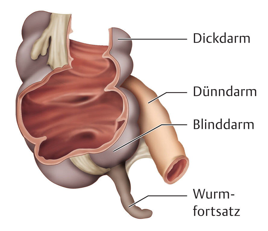 Pflege Von Patienten Mit Appendizitis Eref Thieme