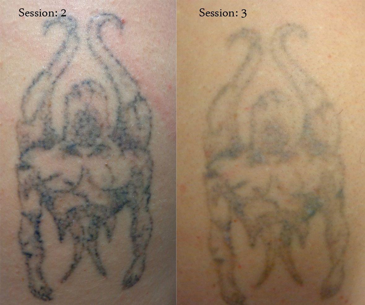 Tattoo Removal – Expressions Tatouages Et Perçages 985_x_1179_jpg