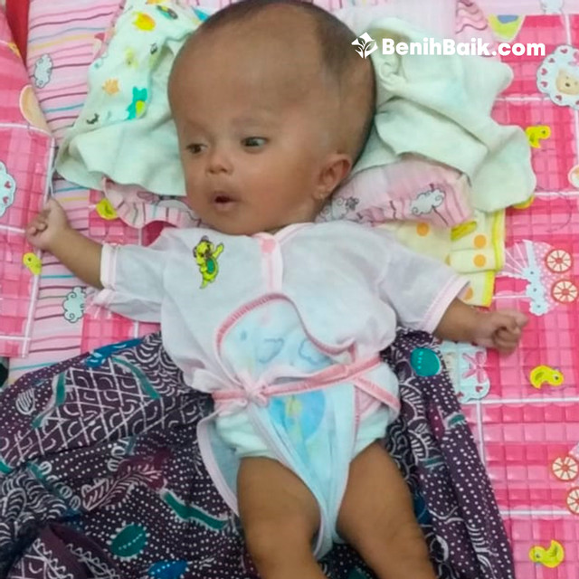 Bantu Bayi Unna Melawan Hidrosefalus - BenihBaik.com