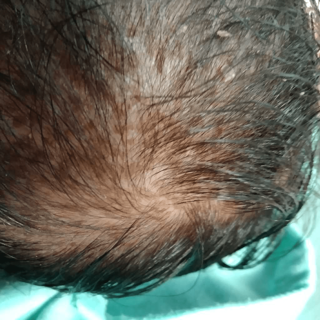 Collection 32+ Pictures bald spot on baby head from sleeping Excellent