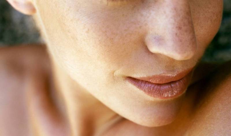 BBL for Skin Discolorations