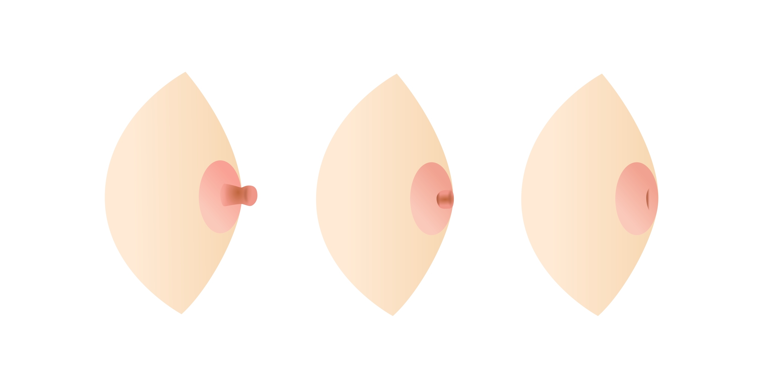 What Inverted Nipple Looks Like