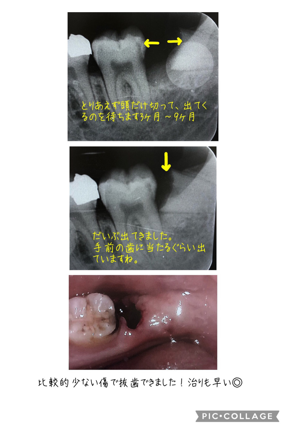 埋まっている親知らずを2回に分けて抜歯する⁉️