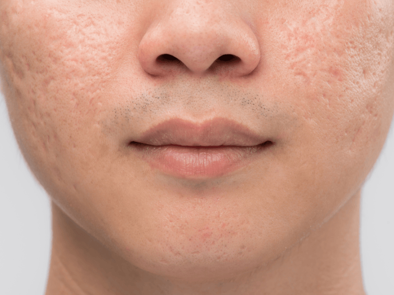 acne scars - Ilustrasi 2
