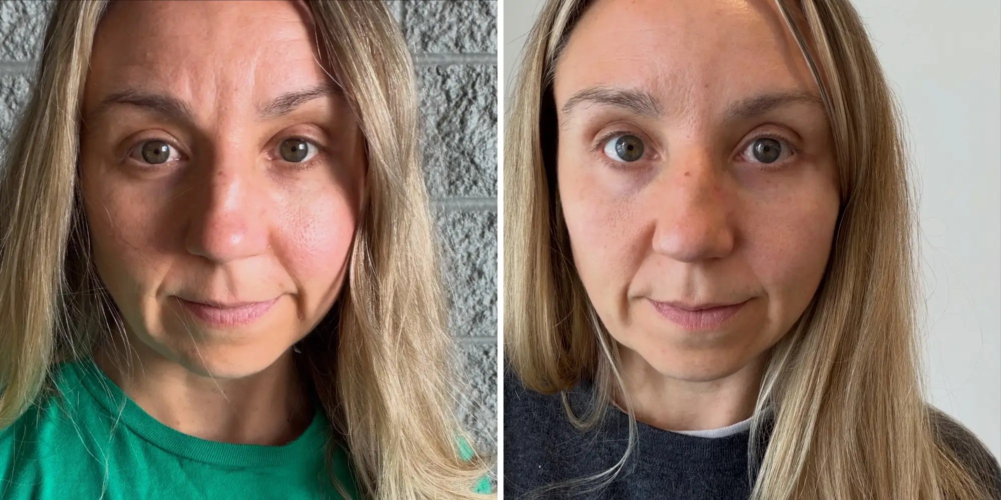 Botox as often as she can afford: why it matters