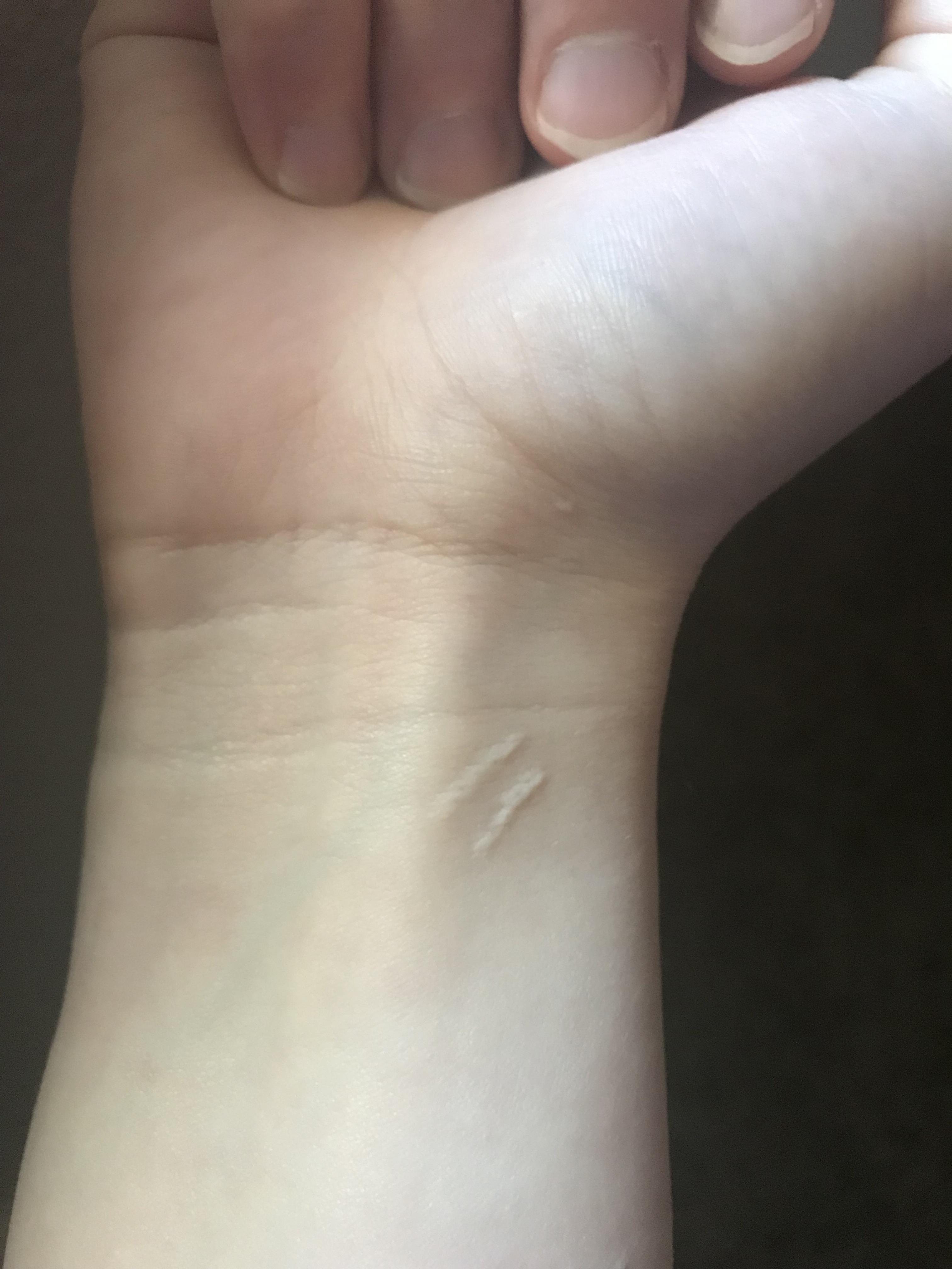 Looking For A Small Tattoo Idea To Cover Up Scars... Any Ideas Would Be Appreciated! : R/Tattooideasdesigns 4032_x_3024_jpg