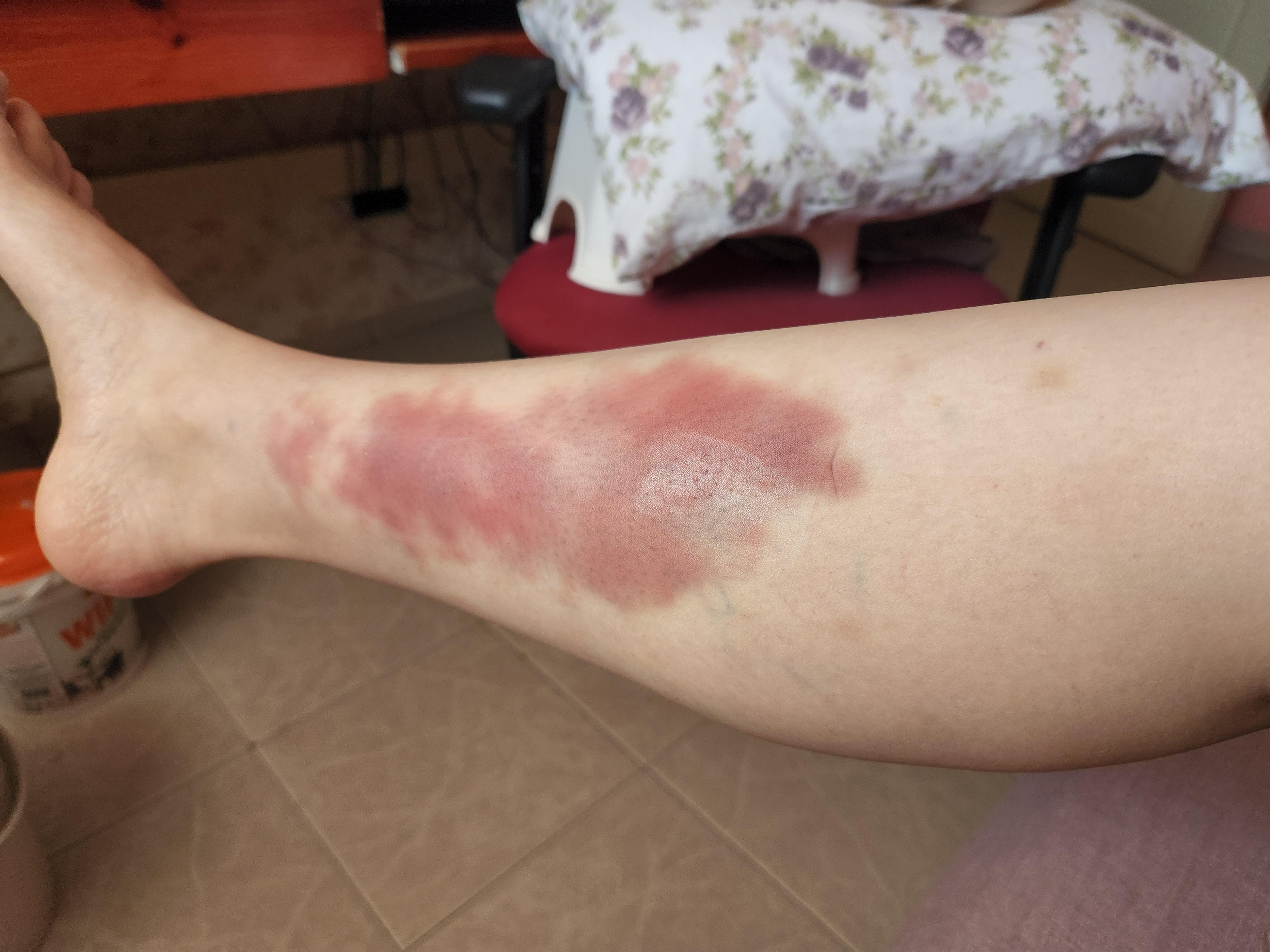 Pole dancing bruises