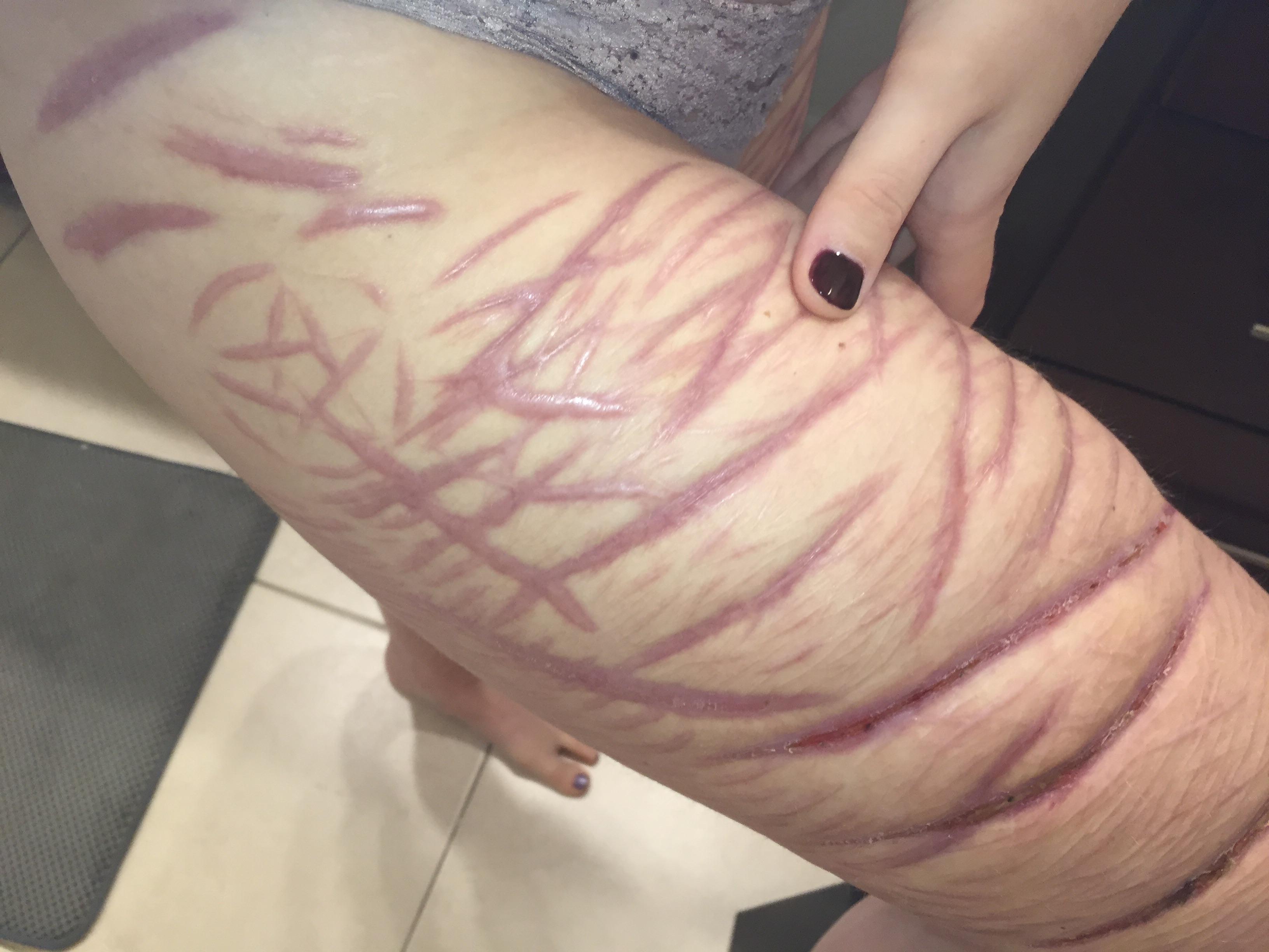 Self harm scars
