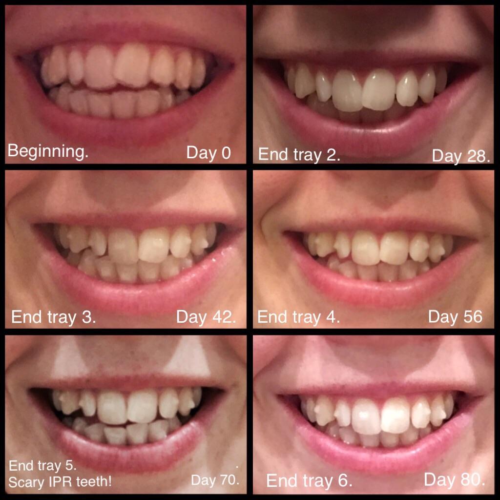 Invisalign progress photos