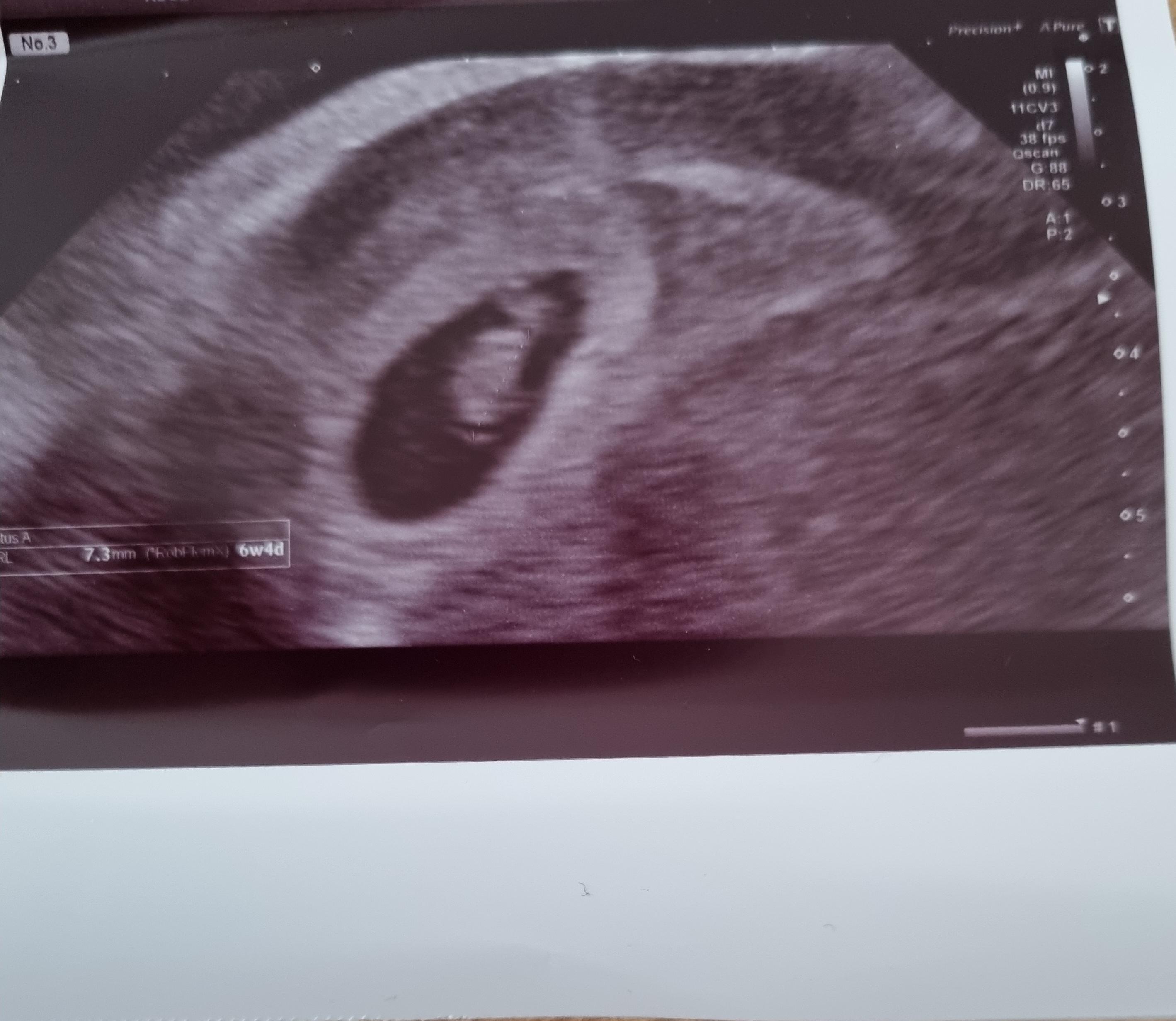 Early reassurance scan at 6+4 how much can you tell? : rPregnancyUK