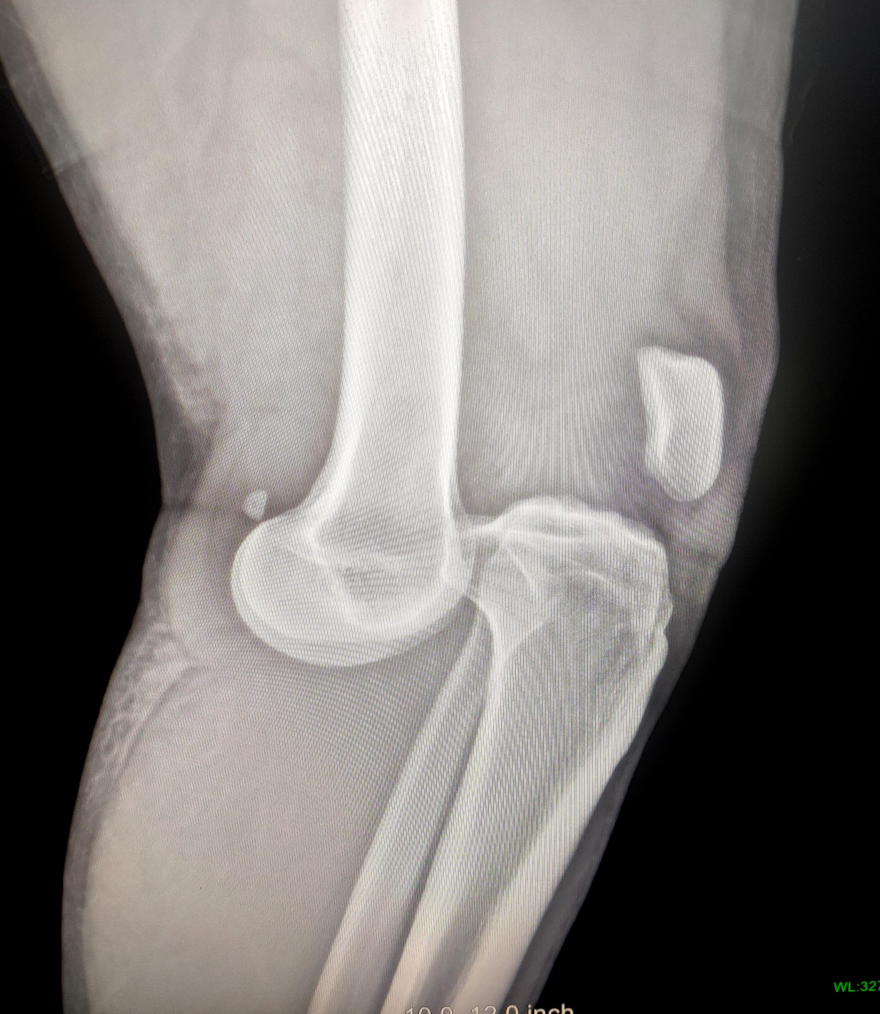 breaking the quiet x ray