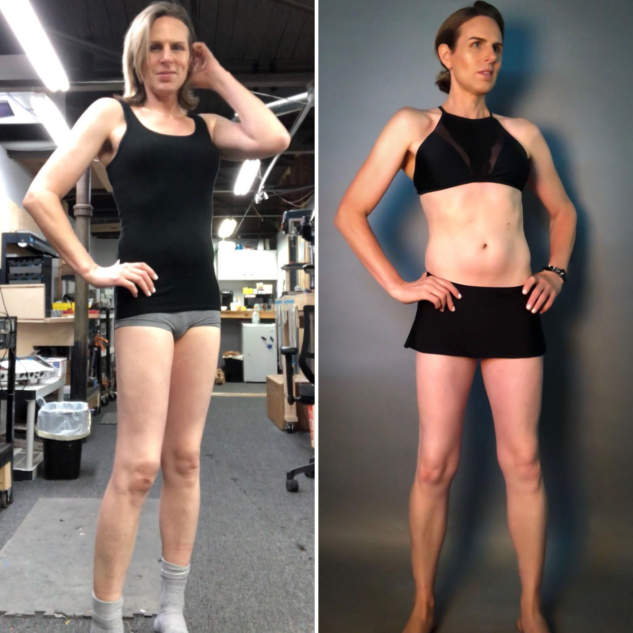 Mtf post op
